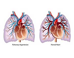 Pulmonary Hypertension - Dr. VT Shah
